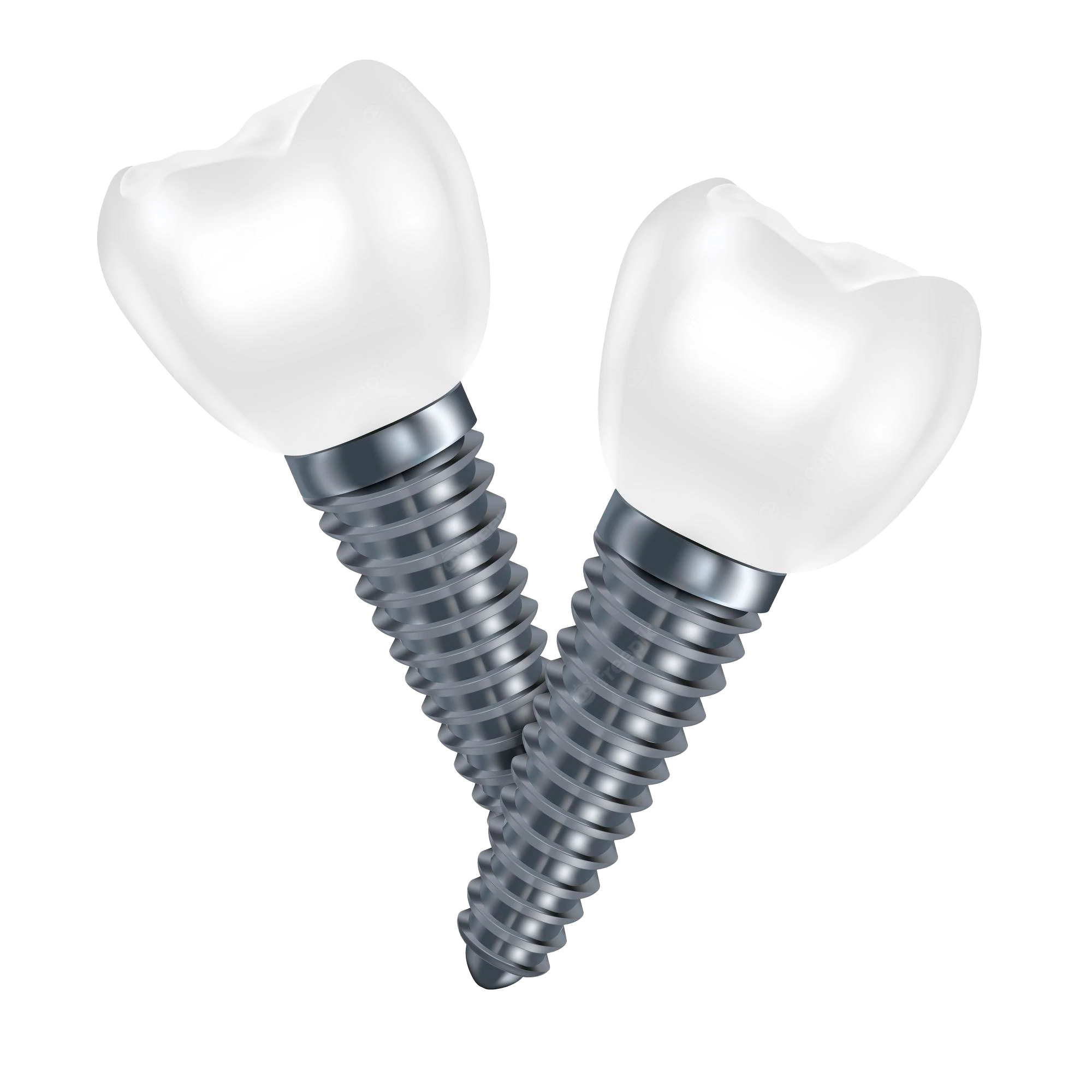 Alinhador Transparente - Borelli Implantes - Implantes dentários e  odontologia